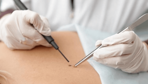 Papile removal features