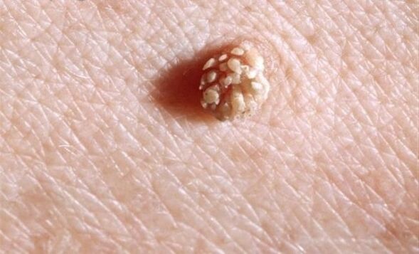Papillomes on the human body