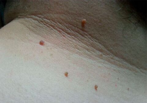 Papillomes on the neck