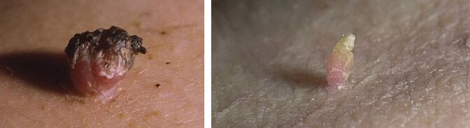 Papillomes on the skin