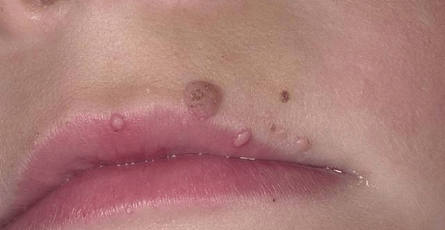 Papillomes on your lips