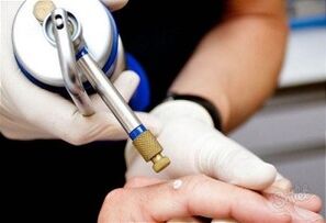 Methods for removing skin papillomas