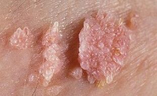 photo of human papilloma virus