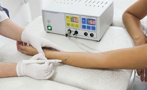 removal of warts with the help of radio waves