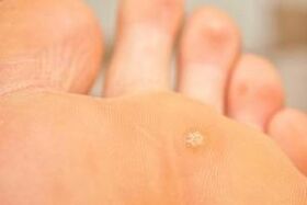 Why plantar warts appear