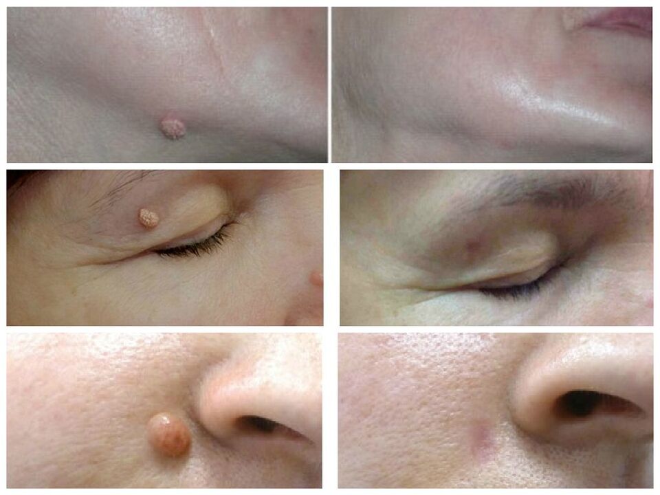 successful removal of warts after using Rimovio gel review Andrew 1
